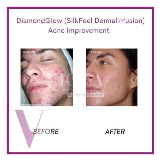 Dermal Infusion Results : Dermalinfusion Procedure, Benefits, Side ...
