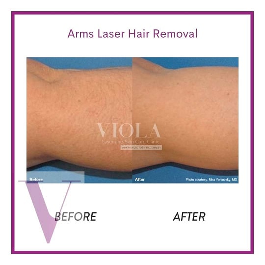 Laser Hair Removal Toronto Viola Laser and Skin Care Clinic