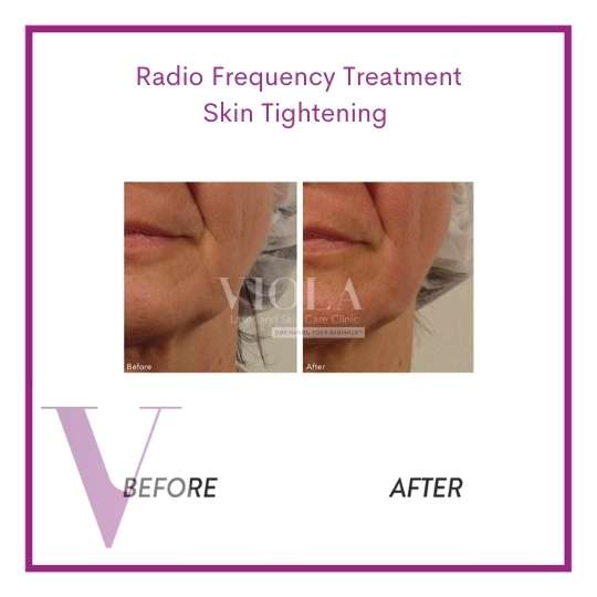 TriPollar Radio Frequency Skin Tightening - Viola Laser and Skin Care ...