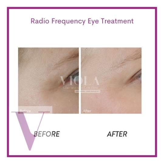 TriPollar Radio Frequency Skin Tightening - Viola Laser and Skin Care ...