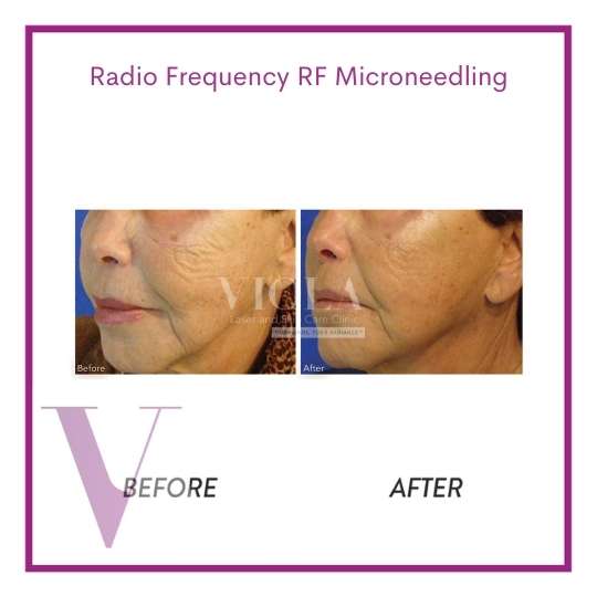 RF Microneedling In Toronto - Viola Laser And Skin Care Clinic