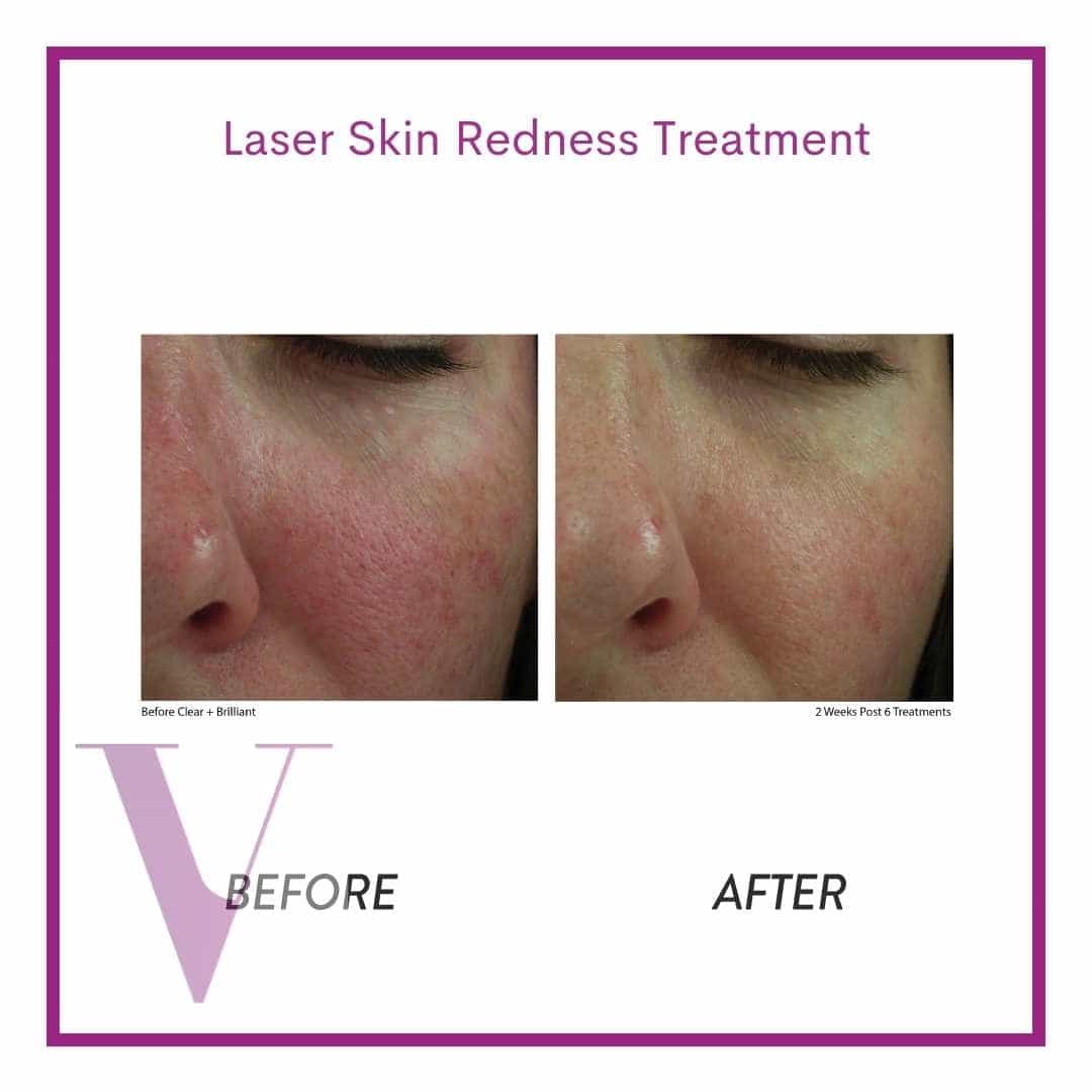 Redness & rosacea Treatment Toronto Viola Laser and Skin Care Clinic