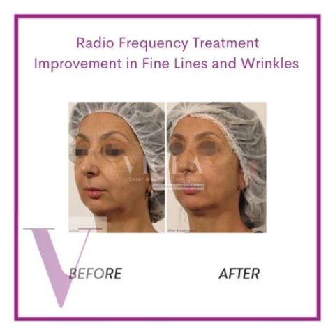 TriPollar Radio Frequency Skin Tightening - Viola Laser and Skin Care ...