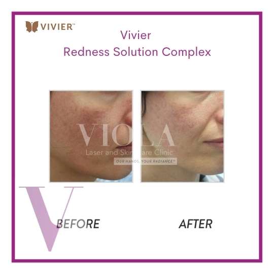 Vivier Skin Care Toronto Viola Laser and Skin Care Clinic