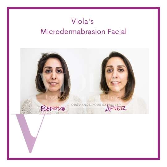 Microdermabrasion Facial in Toronto Viola Laser and Skin Care Clinic